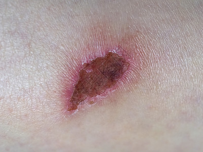 伤疤组织卫生疤痕瘢痕药品真皮保健伤口手臂皮肤感染高清图片