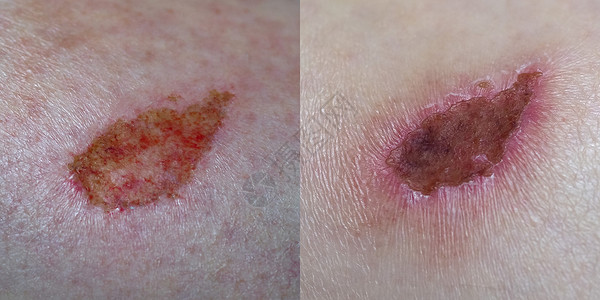 伤疤纹身素材伤疤组织真皮卫生瘢痕疤痕药品感染医疗手臂皮肤伤口背景