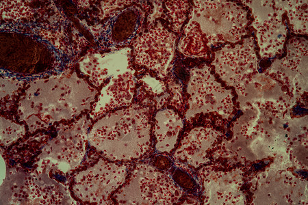 200x 显微镜下的肺组织肺结核组织疾病块茎科学病菌筷子腐烂组织学红色病理学结节背景图片