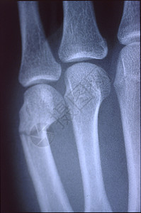 X光图像 男人 手与骨头和关节考试诊断事故医生休息组织x光指骨医院科学背景图片