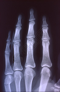 X光图像 男人 手与骨头和关节休息药品医生科学组织指骨事故辐射诊断考试背景图片
