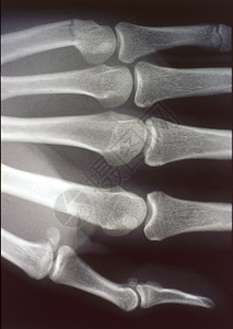 X光图像 男人 手与骨头和关节医生医院指骨辐射组织科学休息诊断药品考试背景图片
