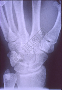 X光图像 男人 手与骨头和关节组织药品诊断医院休息考试科学事故x光医生背景图片