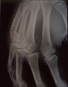 X光图像 男人 手与骨头和关节x光诊断指骨休息医院事故科学药品组织医生背景图片