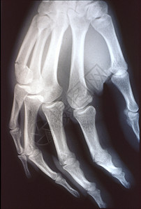 X光图像 男人 手与骨头和关节x光医院药品休息事故考试指骨科学医生诊断背景图片