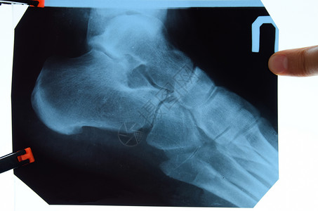 强直性脊柱炎对脚和脚跟骨骼进行X光 对骨头进行X光照片背景