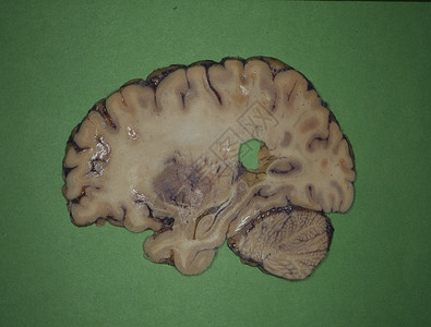 小脑大脑皮层人类大脑被神经切片考试诊断器官科学大脑皮层横截面切面脑干卷积小脑背景