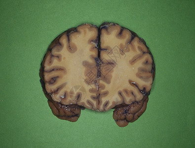 大脑切面人类大脑被神经切片诊断脊髓逻辑横截面大脑皮层药品小脑器官切面回旋背景