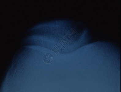 膝盖骨和关节的X光图像髌骨x光烛光男人事故考试指骨辐射组织骨骼背景图片