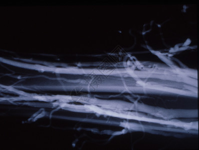 X光片的腿静脉变动关节医生静脉曲张辐射烛光药品黑色考试医院蓝色背景图片