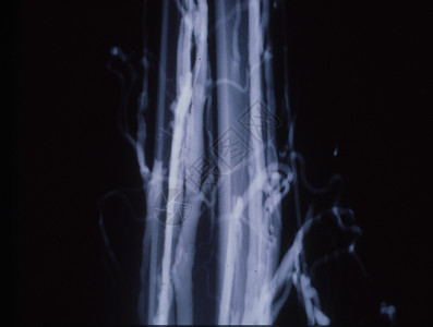 X光片的腿静脉变动关节黑色考试辐射事故诊断医院蓝色医生x光背景图片