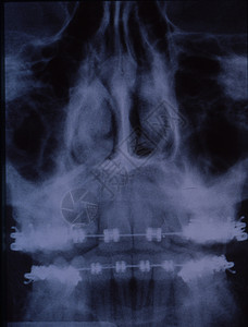 带有牙套和牙齿的斜体X光图像高清图片