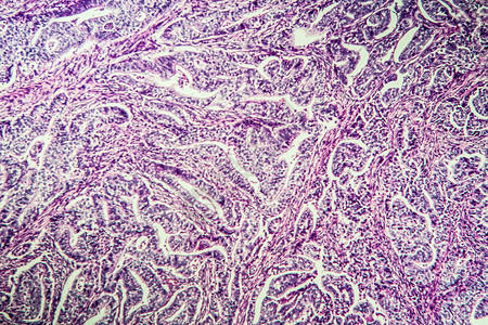 组织第100节组织内胃癌治愈病理诊断考试科学组织学制剂药品癌症宏观背景图片