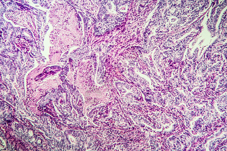 组织第100节组织内胃癌癌症消化组织学考试诊断疾病病理药品科学治愈背景图片