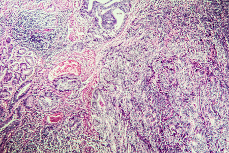 组织第100节组织内胃癌组织学药品宏观科学病理疾病消化治愈制剂癌症背景图片