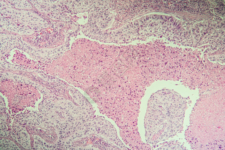 显微镜下鳞状细胞癌病变组织 100病理科学诊断药品疾病考试宏观组织学癌症细胞背景图片