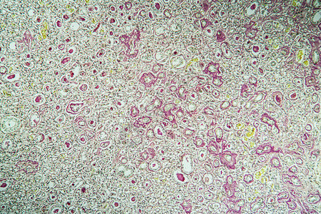 肾脏病科学缩小肾脏高清图片