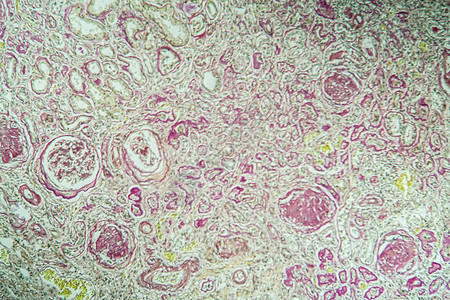 放大缩小显微镜下的肾脏病组织萎缩 100x细胞组织学肾炎诊断疾病肾小球药品肾脏病理考试背景