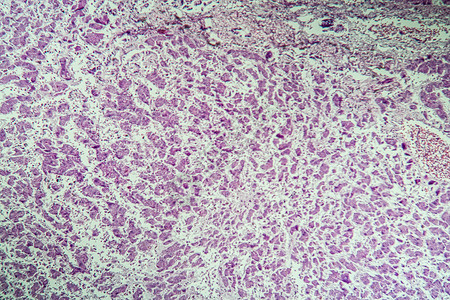 100x 显微镜下的活性肿瘤病组织疾病科学宏观病理组织学癌症诊断考试药品背景图片
