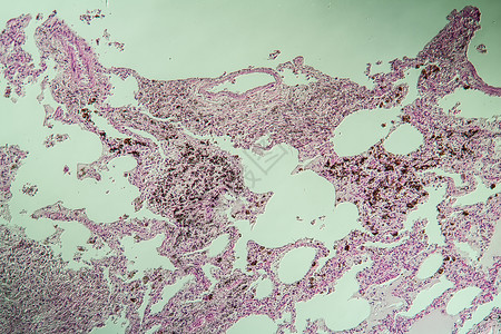 尘肺诊断放大高清图片