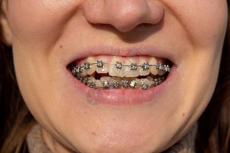 无支架在微笑的嘴唇 宏观光牙齿 闭合的嘴唇 宏观拍摄技术口腔科牙科医生生活治疗压力支架女性牙医背景
