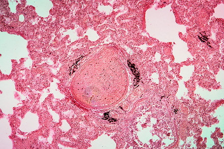 栓塞的脂肪滴显微术高清图片