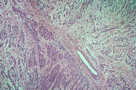 组织学纤维肌瘤研究高清图片