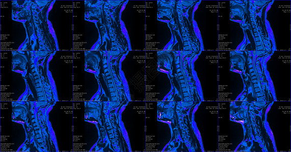 宝马x6一套12个剖面蓝色彩色MRI扫描仪 对C6-C7片段双边半中间体延伸的34岁大白鲸男性颈部区域进行检查背景