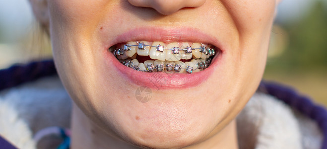 支架拍摄在微笑的嘴唇 宏观光牙齿 闭合的嘴唇 宏观拍摄药品女性矫正卫生治疗女士系统生活牙科搪瓷背景