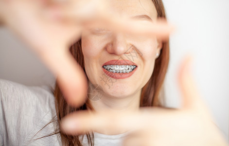 相机支架一个白牙上有牙套的女孩 手握着一副框架牙齿系统金属刷子女士搪瓷嘴唇牙医口腔科压力背景