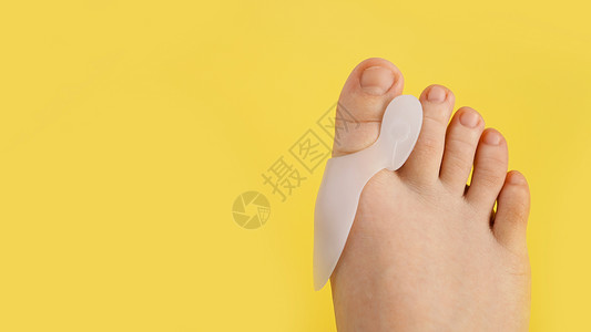 脚拇指外翻Silicone 手指分离器 黄色背景上的整形拇指校正器女性化妆品分隔器美甲凝胶肌腱治疗健康身体疾病背景