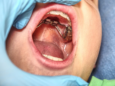 岩蹄兔带固定牙套的嘴巴 口腔正畸方法矫正手套牙医治愈塑料医生病人男生乳牙咀嚼背景