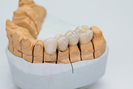 牙体缺损白底孤立的石膏模型上的金属陶瓷桥 克朗阳性体 用显形器制成的陶瓷牙齿背景