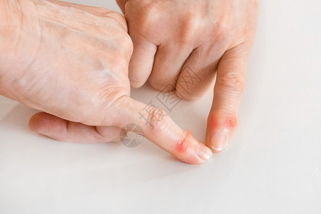 一名老年妇女的两只手表示手指有病 关节情况有所改变接缝情况风湿痛苦女性病人诊所诊断女士畸形疾病症状背景图片