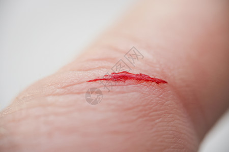 伤者手指指有流血的露口伤口男人流动皮肤照片液体裂伤痛苦伤害病菌事故图片
