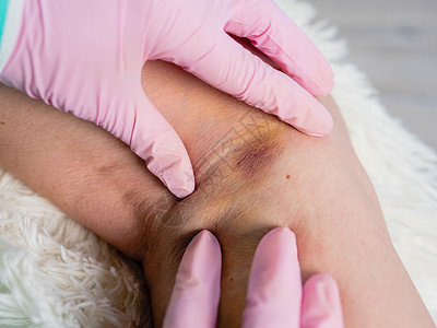 一名身戴医疗手套的外科医生将病人受伤腿转动 对伤者实行急救概念治愈理疗痛苦从业者血肿治疗师关节按摩膝盖创伤背景