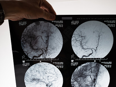 神经病学脑部核磁共振成像扫描图像 手握一张照片药品卫生病人x光疾病医院科学保健颅骨x射线背景