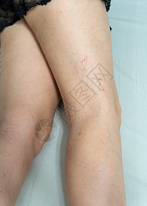 扩张腿医疗的特发性的高清图片