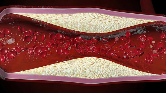 血管由胆固醇血液或容器内引发冠心动动脉病的板块导致的胆固醇血或红细胞流动梗阻动脉硬化牌匾形成镜头毛细管主动脉心脏病学背景