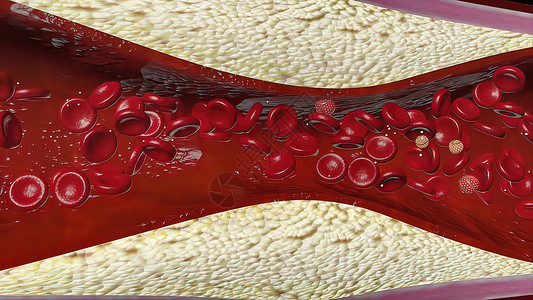 动脉血管堵塞由胆固醇血液或容器内引发冠心动动脉病的板块导致的胆固醇血或3d中风动脉硬化叶子心脏病学静脉形成血管心肌梗阻背景
