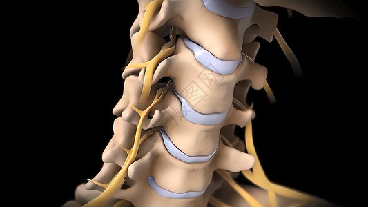 脱垂有神经根的人类脊椎骨干整脊脊髓椎间症状骨科疾病运河绳索诊断背景