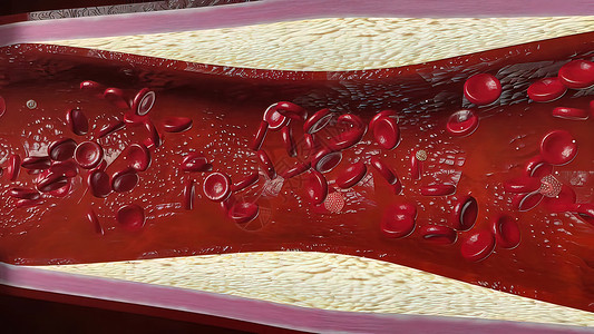 静脉血栓由胆固醇血液或容器内引发冠心动动脉病的板块导致的胆固醇血或动脉牌匾心脏病学水果流动管道渲染镜头主动脉食物背景