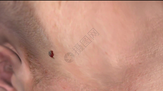 黑色素瘤皮肤表面的黑胎记 (头部和颈部区域)背景