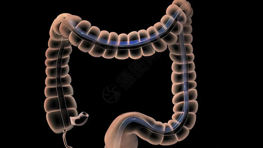 直肠息肉人类消化系统 3D 结肠镜检查程序插图罩衫结肠炎检查胃镜医疗保险疾病诊所息肉外科医院背景