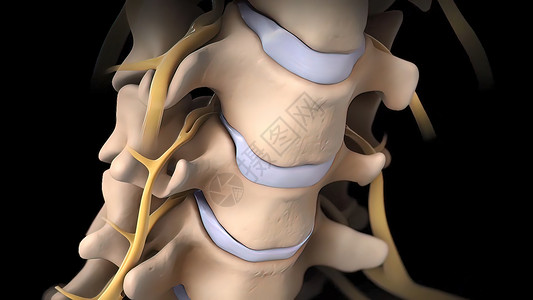 寰椎静脉间脊椎盘片可能会变形 压缩神经的神经疼痛骨科骨骼手术柱子姿势疗法叶片药品诊断背景