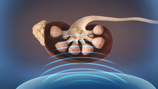 冲击波素材用于去除的心肾细胞冲击波闪电杆菌突变程序卫生侵入性诊断传感器肾脏碎石机控制医院技术定位背景