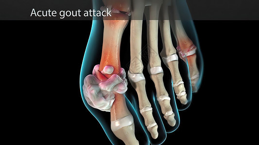 急性甲酸盐按摩疼痛男性糖尿病骨骼痛苦扭伤风湿病脚趾药品背景图片