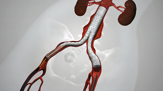 静脉有螺纹的气球血管成形程序导管干涉流动疾病男人动脉硬化金属主动脉手术心血管背景图片