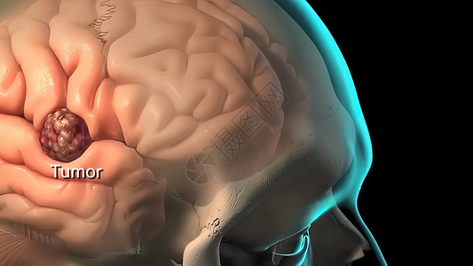 脑癌脑肿瘤是大脑中异常细胞的集合或团块疾病病原病理形象男性生物人脑智力插图化学背景