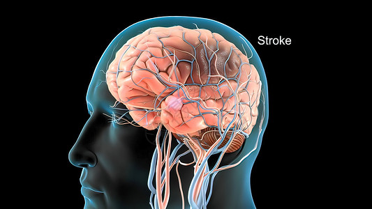 大脑机能图片脑中风3d医疗背景